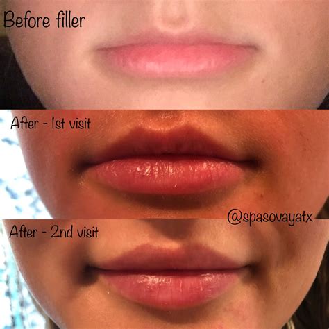 Professional Primp | Lip fillers, Lip fillers juvederm, Lips