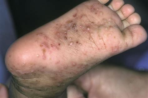 Limited Examination Detects Scabies With High Sensitivity - Dermatology Advisor