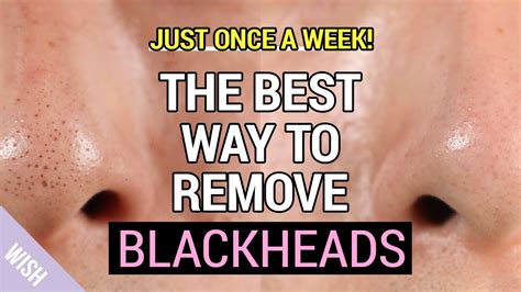 Blackheads Removal Tips