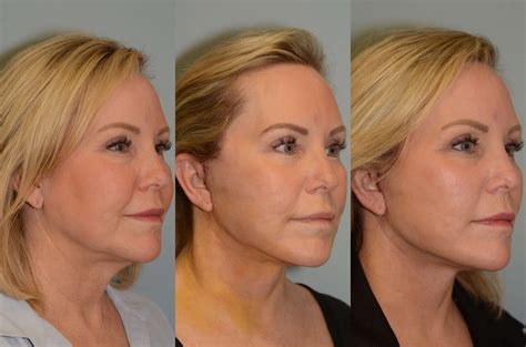 Before and After Facelift & Neck Lift Photos