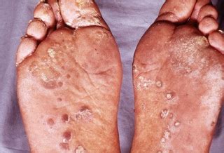 Reactive Arthritis (Reiter's disease, Reiter's syndrome, Fiessinger-Leroy disease, venereal ...