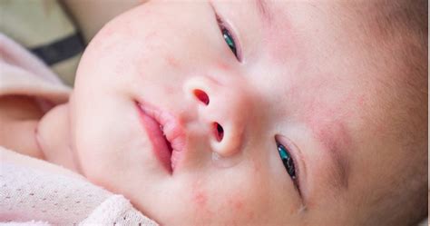Food Allergy Skin Rash Baby