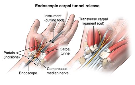 Carpal Tunnel Release | Johns Hopkins Medicine