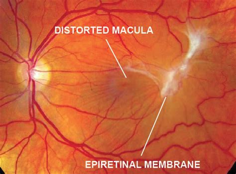 Epiretinal Membrane (Macular Pucker) - Retina Specialists of Michigan