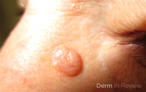 Is it skin cancer? Tumor Identification - Friday Pop Quiz 2/15 - Next ...