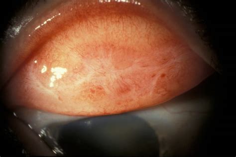 Moran CORE | Conjunctivitis