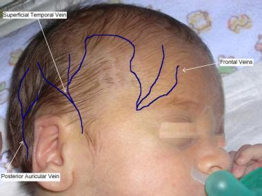 newborn baby veins on head - ค้นหาด้วย Google Diy Reborn Dolls, Reborn Baby Boy Dolls, Bb Reborn ...