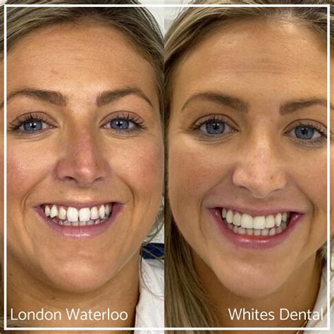 Composite Bonding Before And After Photos | Whites Dental