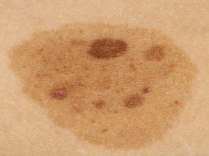 Nevus spilus causes, symptoms, diagnosis & treatment