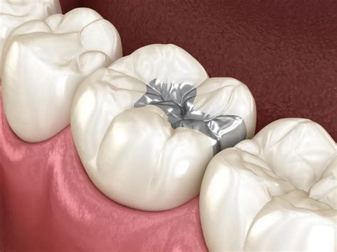 The Truth About Silver Fillings | Risks & Side Effects