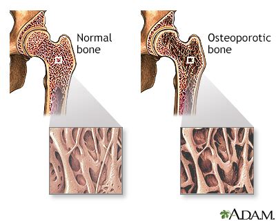 Bone mineral density test Information | Mount Sinai - New York