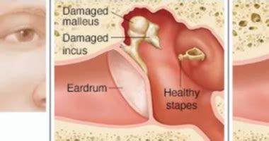 What is Ossiculoplasty Ear Surgery? How is it performed?