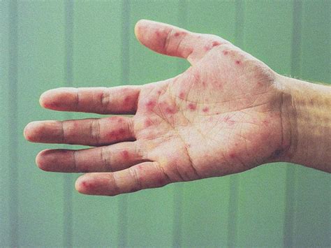 Palm rash: Causes, pictures, and treatments