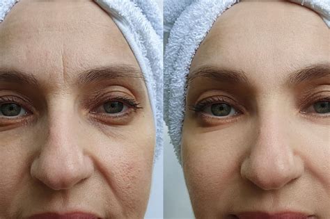 Dysport vs Botox: What is the Difference and Which One is Best For You? | iThriveBeauty