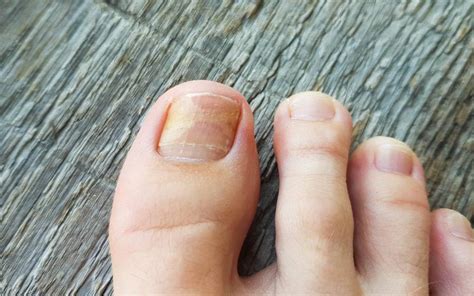 Hydrogen Peroxide Toenail Fungus Before And After - lvandcola