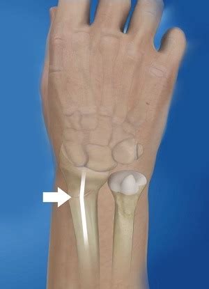 Malunion of a Fracture Telluride, Colorado | Wrist Fracture Gunnison, Colorado