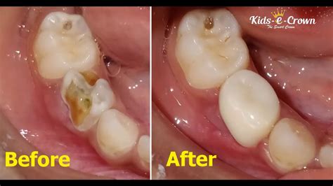 Zirconia Crowns Passive Fitment Procedure - Kids-e-Dental - YouTube