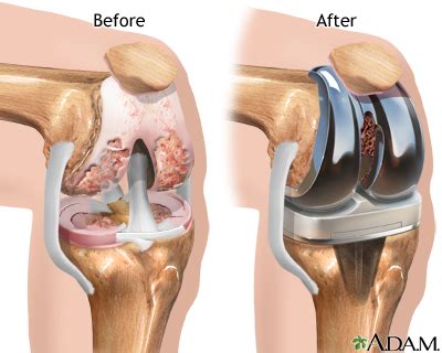 Different Types of Knee Replacement Implants