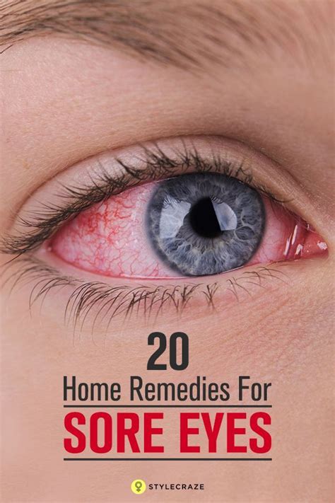 20 Effective Home Remedies For Sore Eyes Dry Eye Remedies, Allergy ...