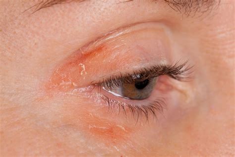 Psoriasis on the Eyelids: Symptoms, Risks, Treatment