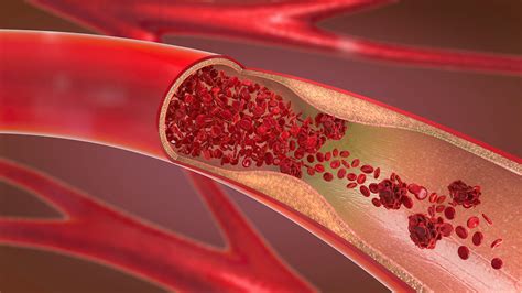 Endothelial Dysfunction: A Common Factor in Diabetes, Atherosclerosis ...