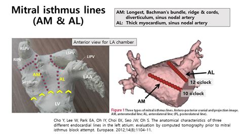 Other Seminars - Left Atrial Anatomy at APHRS2017 Asia Pacific Heart Rhythm Society Scientific ...