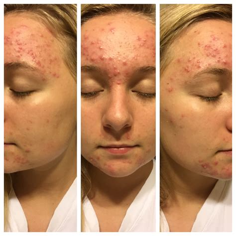 Tretinoin Before After, Before and after month 2 on 05% tretinoin cream ...