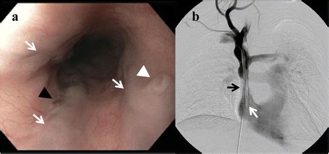 Bleeding ‘downhill’ esophageal varices associated with benign superior vena cava obstruction ...