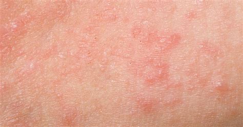 What is scabies? Everything you need to know about scabies rash.