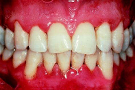 Common Dental Problem And Solution: Gingivitis: Cause and Management