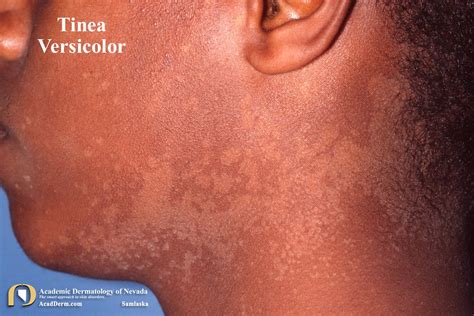 Evoked Scale Sign Of Tinea Versicolor Dermatology Jam - vrogue.co