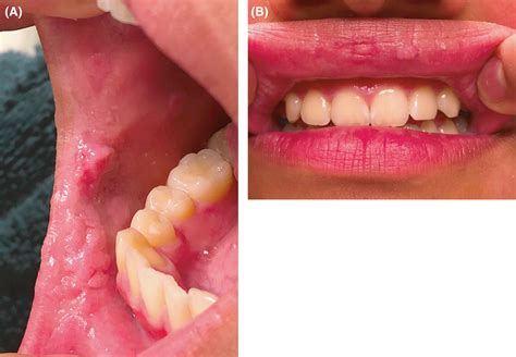 Squamous Papilloma Tongue