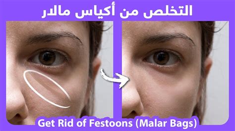 How to naturally get rid of Malar bags, or Festoons | التخلص من أكياس ...