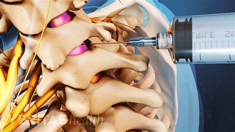 Epidural Steroid Injection Needle