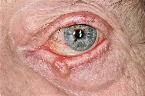 Basal Cell Carcinoma On Eyelid