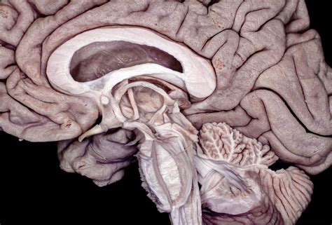 Medial Perspective of partially dissected Brainstem, Diencephalon and ...