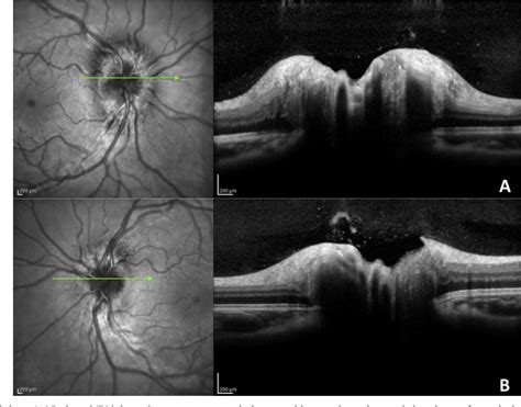 Figure 1 from Differentiating mild papilledema and buried optic nerve head drusen using spectral ...