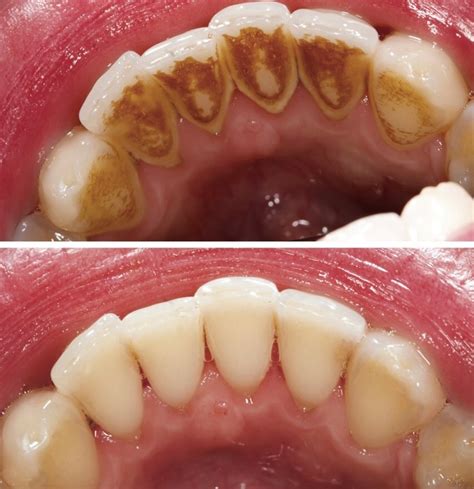 Before and after calculus removal.... - Apple Family Dental