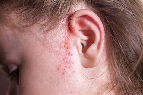 The Symptoms, Causes, Treatment and Prevention of Impetigo - Page 2 of 5 - HealthVibe