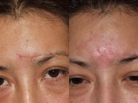 Before & After Pictures | Scar Revision Chicago, IL |Dr. Sidle