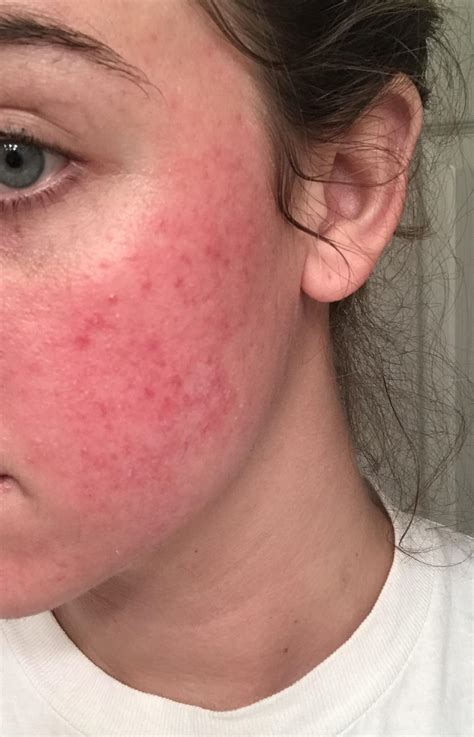 Could this be acne rosacea? This has been on my face for 6 months now. : r/Rosacea