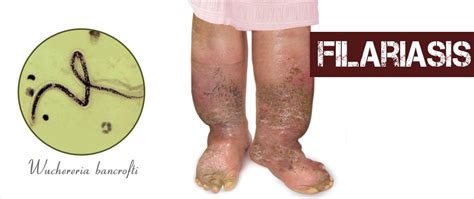 Filariasis - Causes, Symptoms, Diagnosis and Treatment , FAQs