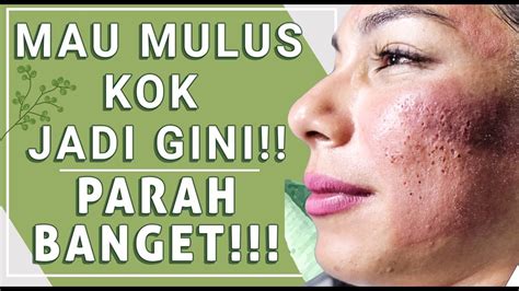 Menghilangkan Muka Bopeng Bekas Jerawat & Pori besar || Acne Scars ...