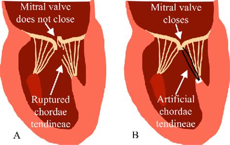 Patient-Specific Subvalvular Apparatuses Consisting of Chordae ...