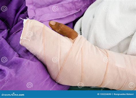 Broken Arm Bone with Splinting Stock Photo - Image of medical, bone: 155224690