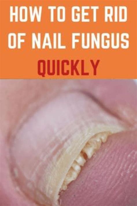 It is a fungal infection that may spread to the skin surrounding the affected toe and other ...
