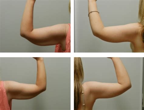 How To Get Rid Of Fatty Arms - Heightcounter5