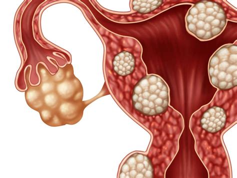 Miomas: causas, sintomas e tratamento - Respostas Sempre Atualizadas