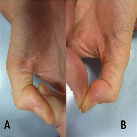 Bowstringing after Trigger Finger Release: A Case Report