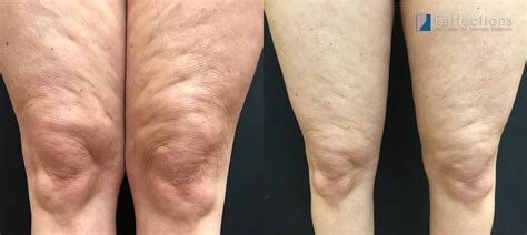 Cellulite Causes And Grades: What To Know About This Common, 58% OFF